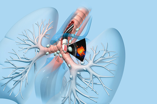 EBUS Endobronchial Ultrasound in Prayagraj at Haridaya Super Speciality Centre Prayagraj Dr. Ashish Tandon 